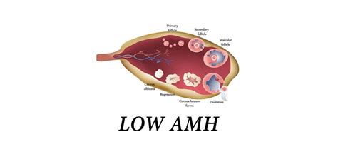 Low AMH Causes And Low AMH Ayurvedic Treatment