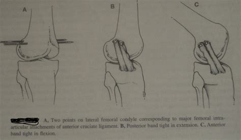 Anterior Cruciate Ligament Acl Reconstruction Physiopedia