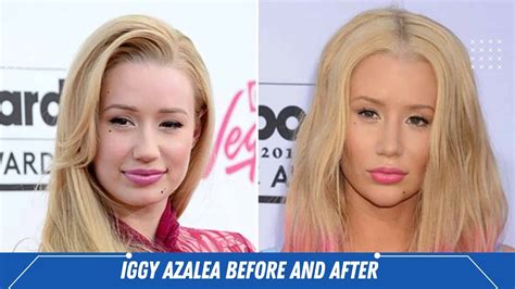 Iggy Azalea Before And After Everything You Need To Know About Her Surgery