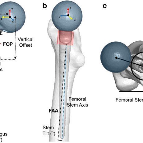 Example of simulation of femoral neck osteotomy at different neck ...