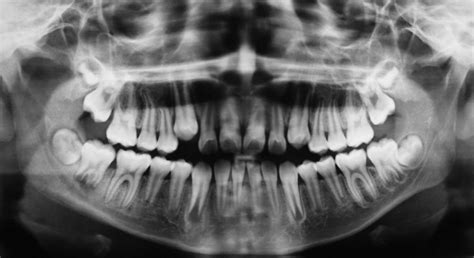 Radiografii Panoramice Dentare Centrul Medical Brancusi