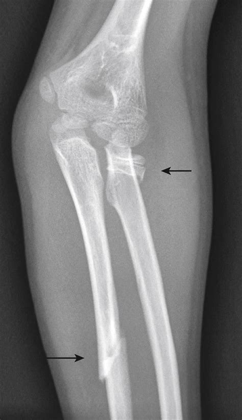 Fractures and Dislocations in Children - Clinical Tree