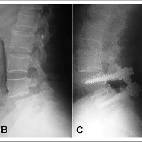 Images Of L Grade I Isthmic Spondylolisthesis A Sagittal T Wi