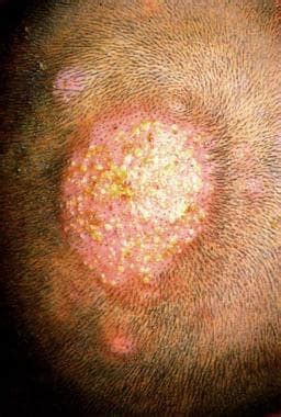 Tinea Capitis Clinical Presentation History Physical Examination