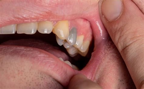 What Causes Black Teeth In Adults Dentistry Of Kingwood