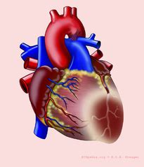 File:Heart with AL infarct.png - ECGpedia