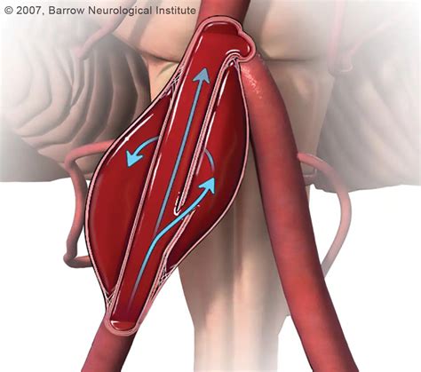 Aneurismas Cerebrais O Que Causa Sintomas E Tratamentos