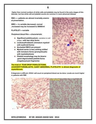 Myelofibrosis | PDF