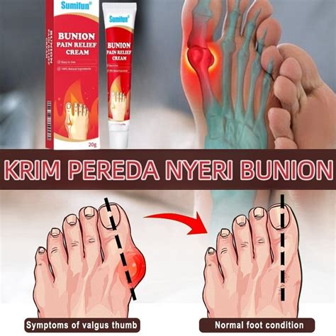 Jual Salep Pereda Sakit Nyeri Sendi Salep Rematik Bunion Pain Relief