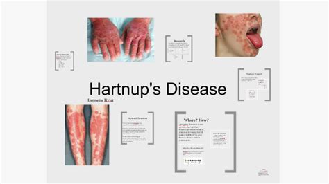 hartnup s disease Hartnup disease rash keto pellagra syndrome symptoms ...