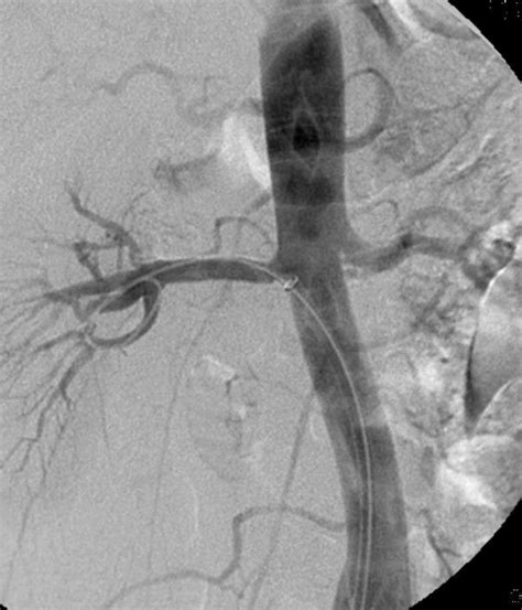 Selective Right Renal Angiography Following The Placement Of A 6 × Download Scientific Diagram