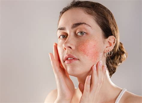 Rosacea Symptome Trigger Behandlung geröteter Haut