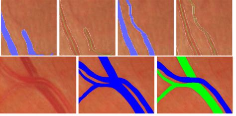 Editing Segmentation Results Automatically Corrects Skeletonization