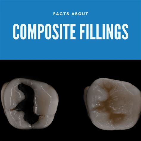 Facts About Composite Fillings Channo Dds