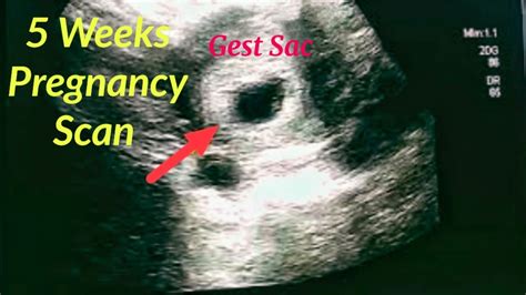 Ultrasound Weeks Gestation Early Pregnancy Scan Gestational Sac