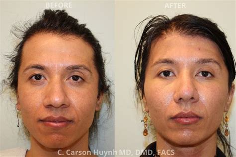 V Line Jawline Surgery Case 2171 Radiance Surgery And Aesthetic Medicine