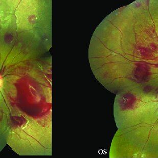 Od Fundus Photo Of The Right Eye Showing Multiple Subinternal Limiting