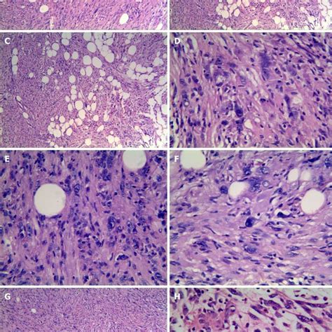 Clinicopathological Features Of Four Cases Of Superficial Cd Positive