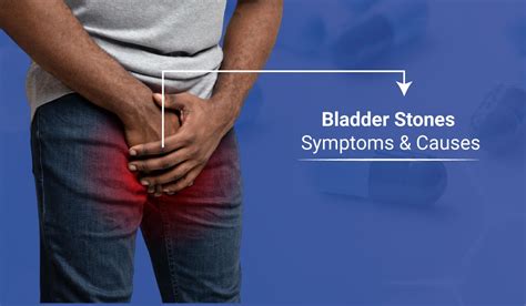 Bladder Stones: What You Need to Know About Symptoms & Causes