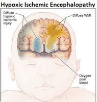 Define Hypoxic Ischemic Encephalopathy - Assignment Point