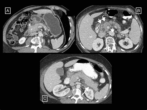 Radiología de la pancreatitis aguda hoy: clasificación de Atlanta y