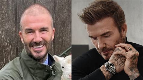 Beckham Hair Transplant - SULE HAIR TRANSPLANT