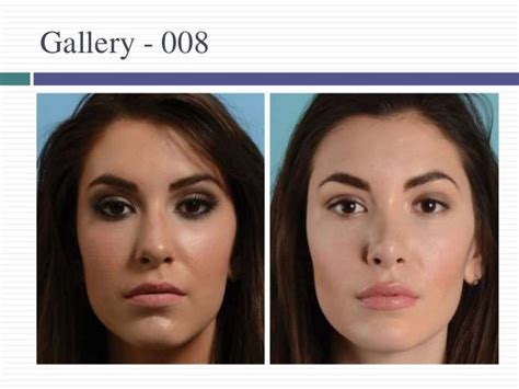 Rhinoplasty Surgery Sydney Australia