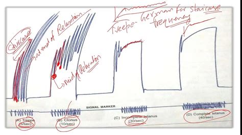 Genesis Of Tetanus And Fatigue Graphs Practical Physiology Youtube