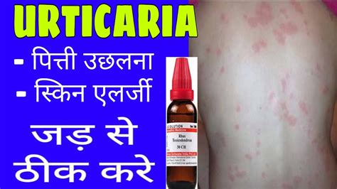 Urticaria Cause And Symptom Urticaria Homeopathic Medicine How To Get