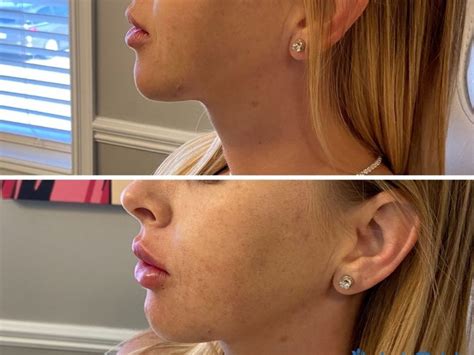 Lip Injections Tulsa OK Align Injectable Aesthetics