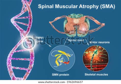 Aatrophie Musculaire Spinale SMA Trouble Neuromusculaire