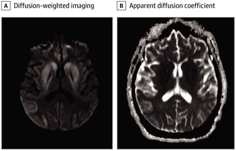 Ocular Dipping In Anoxic Brain Injury Critical Care Medicine Jama