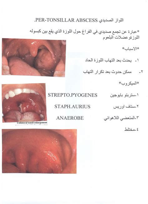 المدونة الطبية د فهيد سالم السبيعي اللواز الصديدي PERI TONSILLAR ABSCESS