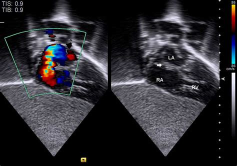 Echocardiography Of Hypoplastic Left Heart Syndrome Cardiology In The Young Cambridge Core