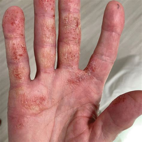 Allergic Contact Dermatitis On The Hand To Multiple Fragrances