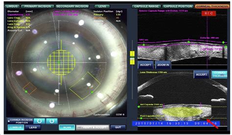 Intraoperative As Oct Of The Right Eye Tilting Lens With Deep Anterior