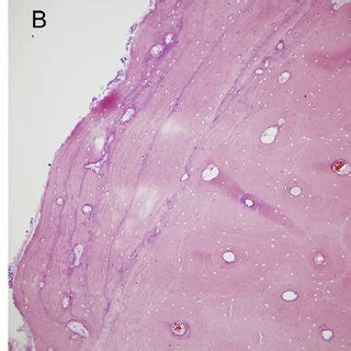 (PDF) Diagnosing Osteomyelitis: A Histology Guide for Pathologists