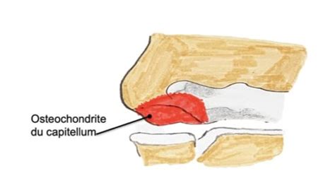 Pathologies Du Coude Clinique De L Paule Du Coude