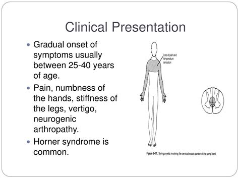 PPT - Syringomyelia PowerPoint Presentation, free download - ID:1370411