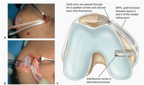 Medial Patellofemoral Ligament Reconstruction | Musculoskeletal Key