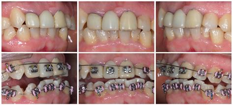 Caso Cl Nico Con Brackets Met Licos Precision Ortodoncia Y Pr Tesis En