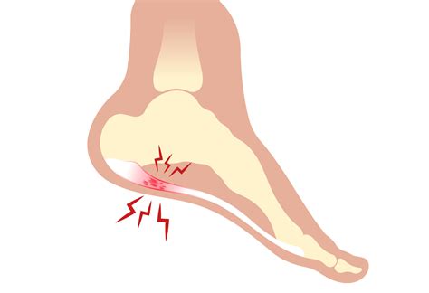 Fascite Plantar Causas Sintomas E Tratamento Instituto Trata