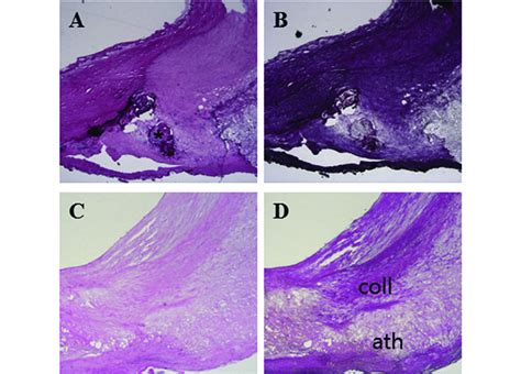 Fig A And B Histologic Samples Of Atherosclerotic Plaques Retrieved