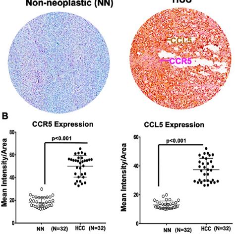 Ccr5 And Ccl5 Are Overexpressed In Liver Cancers Lcas Compared To