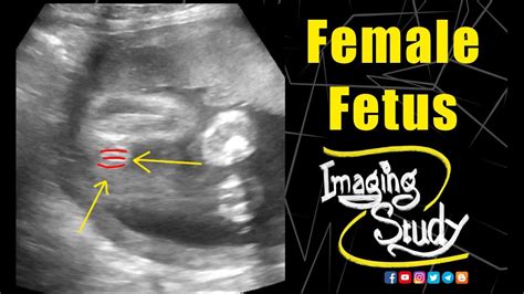 Female Fetus 25 Week Ultrasound Case 204 Youtube