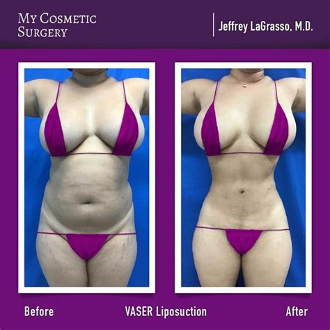 Transformative Lipo Vaser Journey At My Cosmetic Surgery Miami