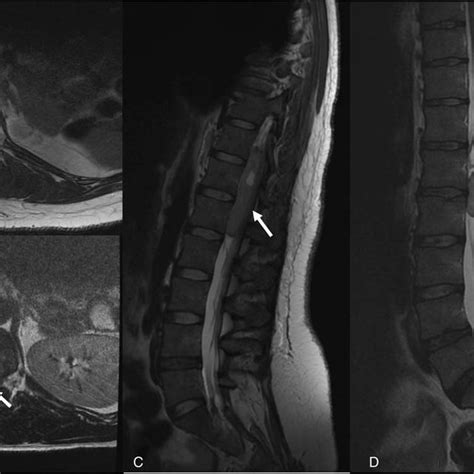 Lumbar Axial T1 Weighted Magnetic Resonance Imaging MRI Sequence