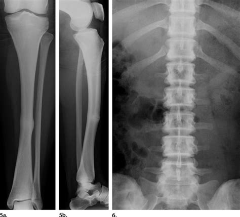 6 Pyknodysostosis 5 Anteroposterior A And Lateral B Download Scientific Diagram