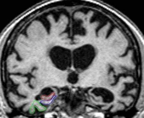 MRI brain scans accurate in early diagnosis of Alzheimer's disease | (e ...