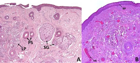 Histologic Sagittal Section Of The Dermoid Lesion It Shows Stratified